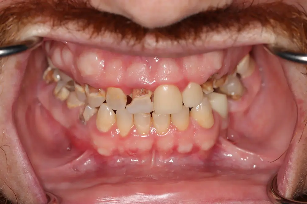 male patient before all on 4 dental implants procedure